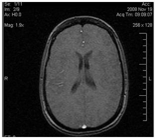 Brain MRI Image showing white matter in the center